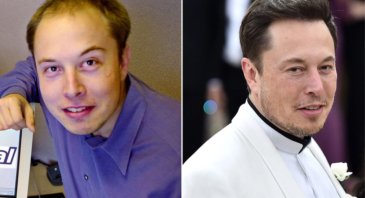 Elon Musk Hair Transplant: 7 Shocking Facts About His Billion-Dollar Mane Makeove